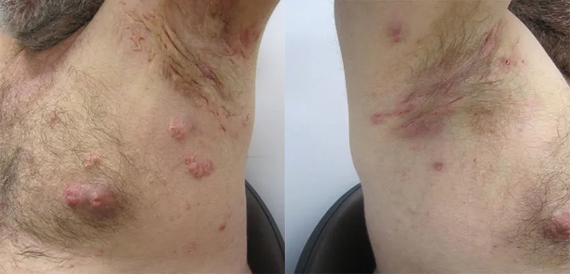 Hidradenitis Suppurativa