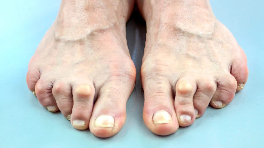 Arthritis in the Legs